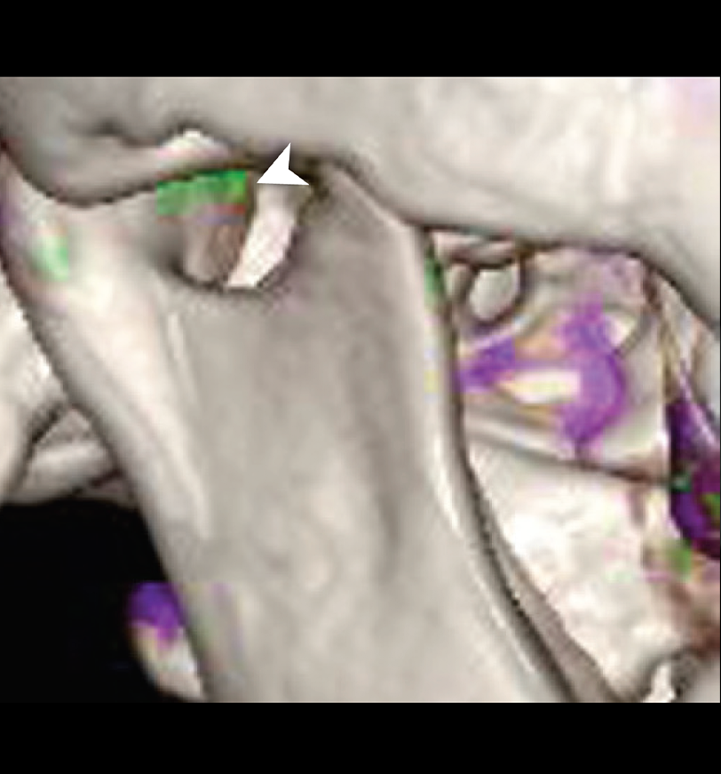 DECT scan revealing urate crystals in temporomandibular joint