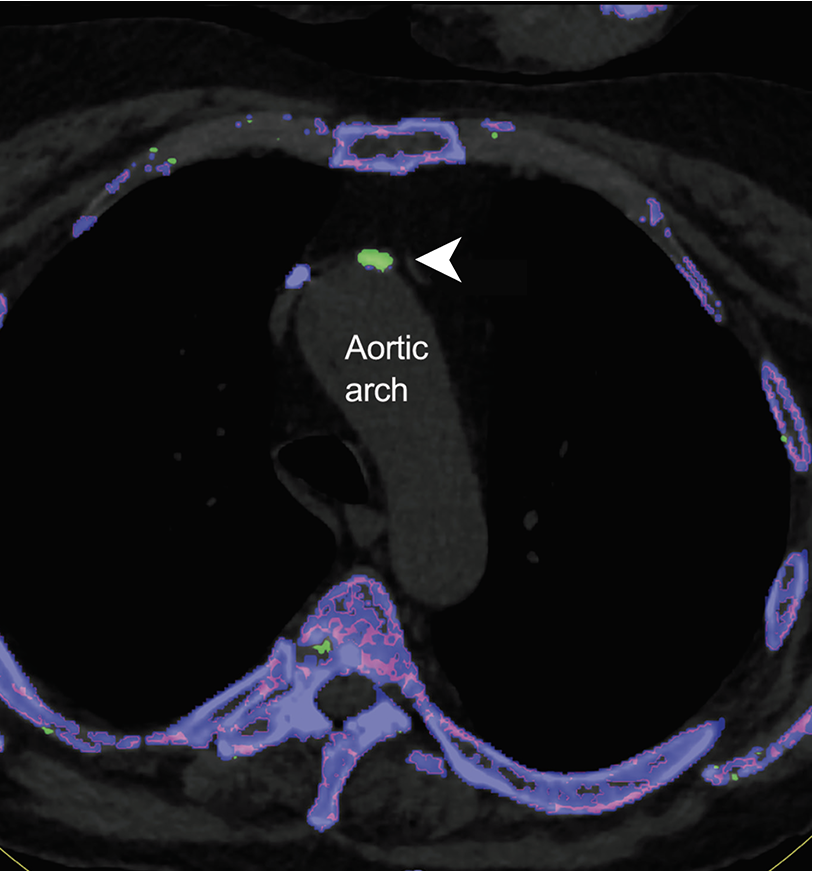 DECT scan of uric acid deposition in aortic arch of heart