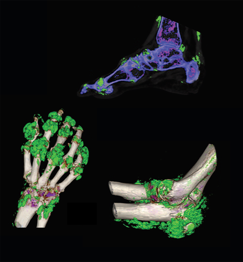Multiple Dual Energy CT scans showing urate deposits in feet and ankles, the Achilles tendon, hand, wrist, and elbow