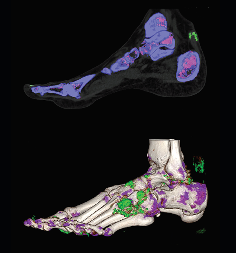 Dual Energy CT scan revealing uric acid deposition in the feet, including along the Achilles tendon, midfoot, and ankle joint