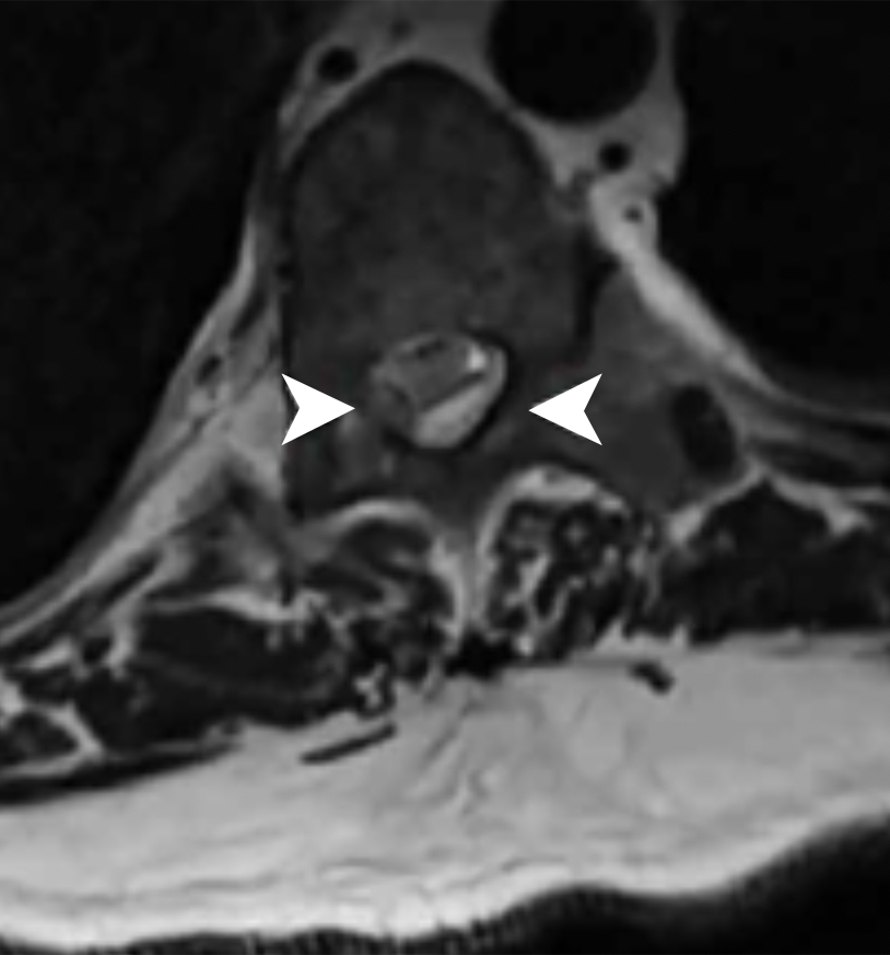MRI of gouty tophi in spine