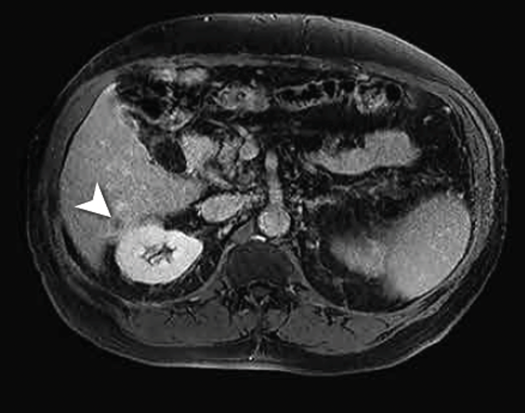 MRI of an atypical nodule later confirmed to be gouty tophi in the liver