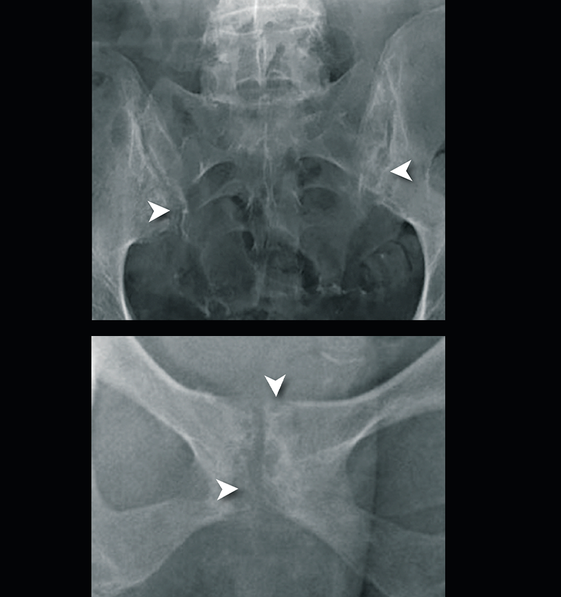 Radiograph of gouty arthropathy and bone erosion in hip