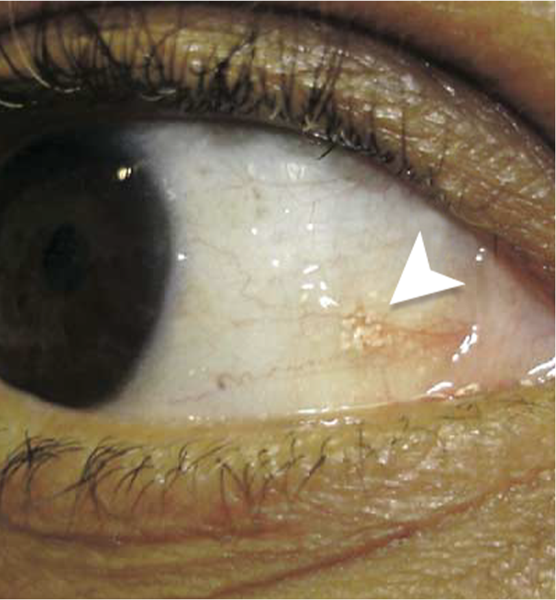 Urate deposits in the eye of a patient with tophaceous gout